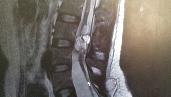spinal cord injury attorney in Manassas VA